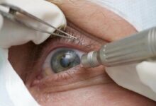 SUS restringe cirurgia de mudança de cor dos olhos para cegos
