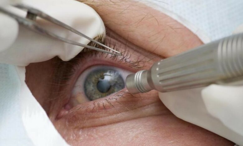 SUS restringe cirurgia de mudança de cor dos olhos para cegos
