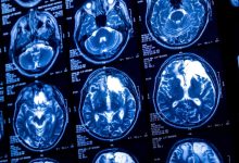 Sam Altman lança startup de chip cerebral para rivalizar com Neuralink