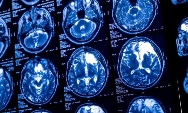 Sam Altman lança startup de chip cerebral para rivalizar com Neuralink