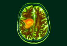 Pesquisa indica que dieta pode facilitar tratamento do câncer cerebral