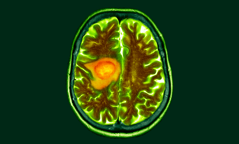Pesquisa indica que dieta pode facilitar tratamento do câncer cerebral