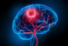 Estudo mapeia rotas de fuga de tumores cerebrais