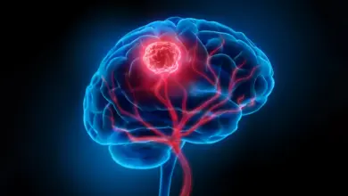 Estudo mapeia rotas de fuga de tumores cerebrais
