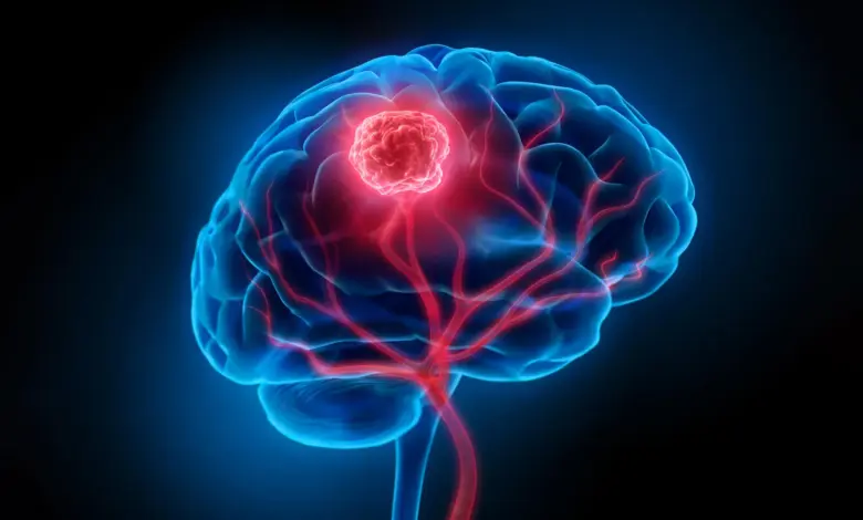 Estudo mapeia rotas de fuga de tumores cerebrais