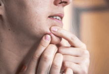 Pesquisa cria novo adesivo eficaz contra acne