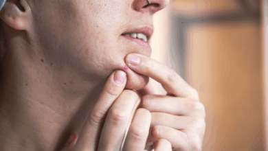 Pesquisa cria novo adesivo eficaz contra acne