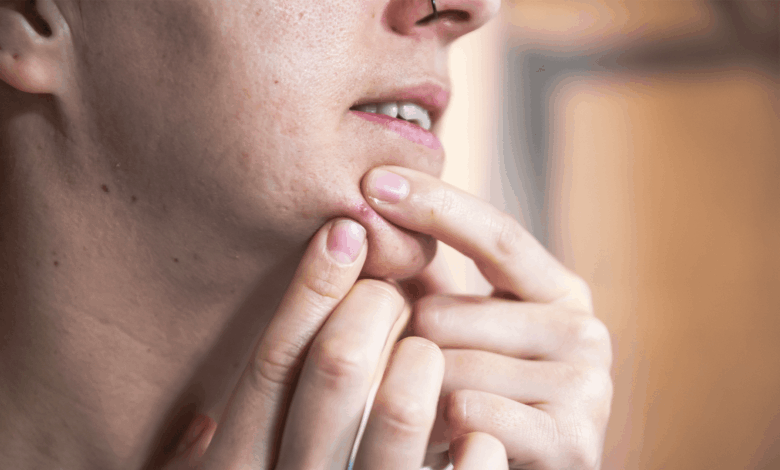 Pesquisa cria novo adesivo eficaz contra acne