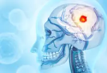Pesquisa revela câncer cerebral que consome o crânio