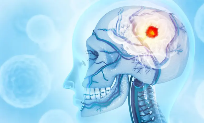 Pesquisa revela câncer cerebral que consome o crânio