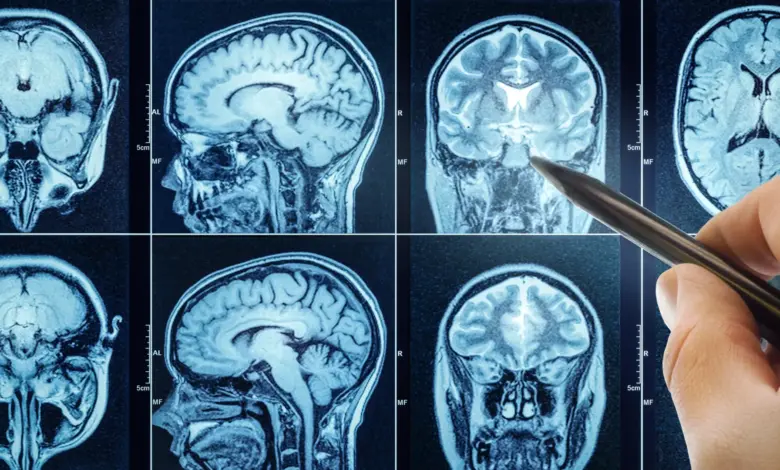 Estudo liga sono inadequado ao envelhecimento cerebral