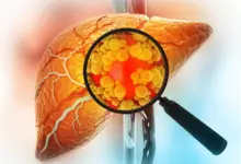 Estudo revela causa real de mortes por doença hepática