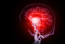 Cientistas identificam lesão cerebral oculta em estudo sobre demência